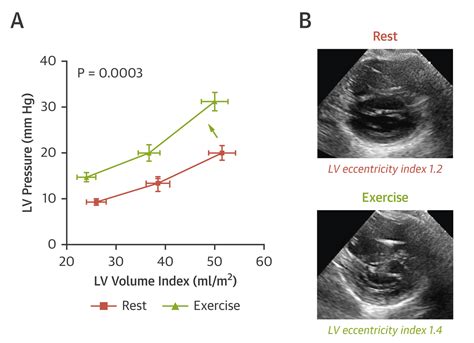 d shaped lv|pericardial restraint heart failure.